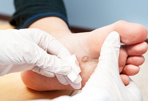 Foot with Warts — Pensacola, FL — Pensacola Podiatry P.A.