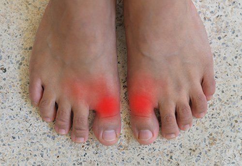 Painful Hallux Limitus — Pensacola, FL — Pensacola Podiatry P.A.