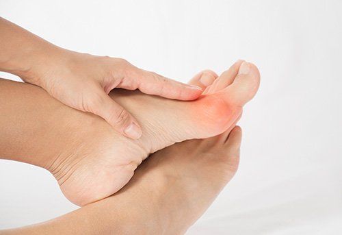 Bunions on Feet — Pensacola, FL — Pensacola Podiatry P.A.
