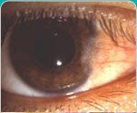 Pterygium