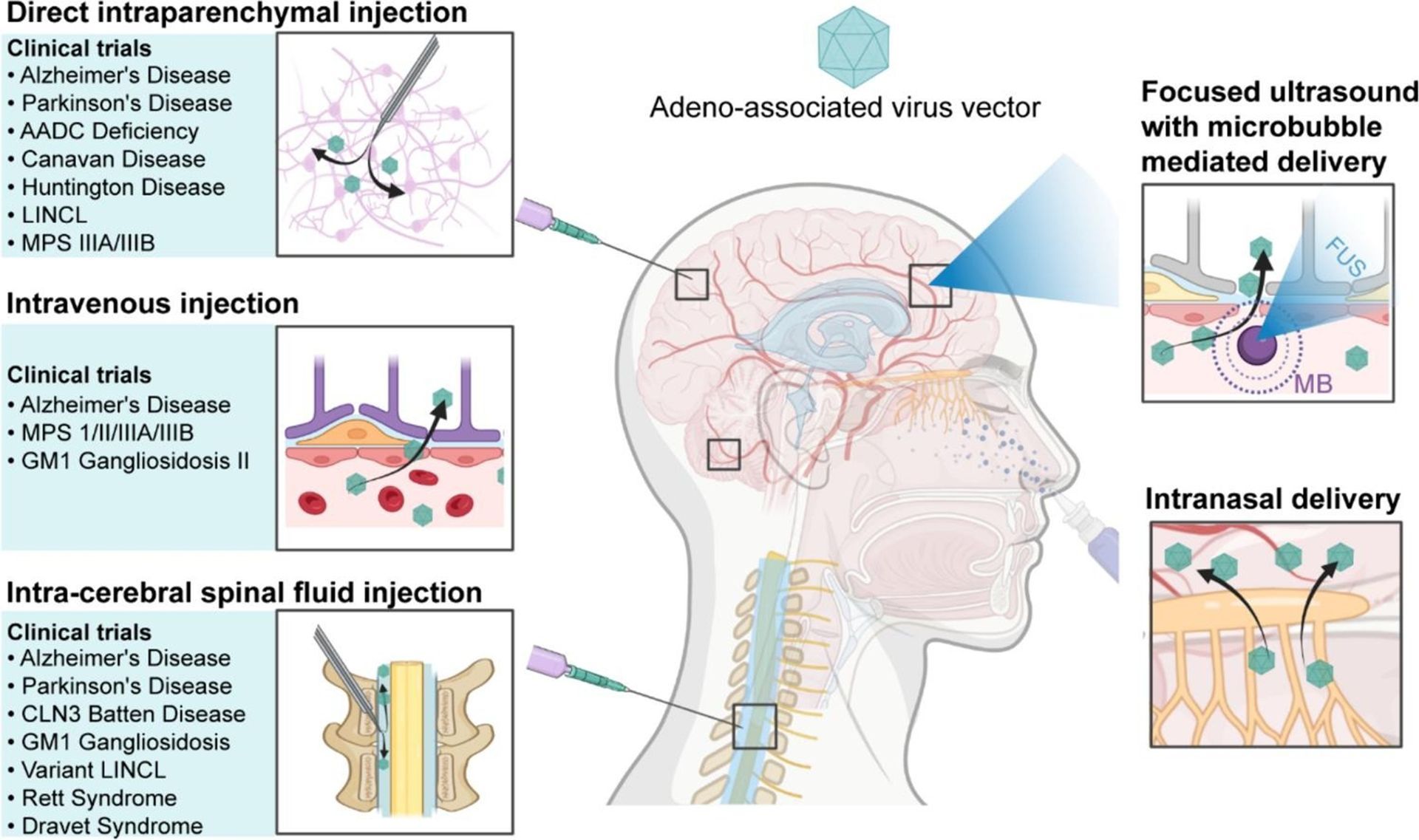 Diagram showing routes for AAV-mediated virus vector delivery to the brain: direct, intravenous, spinal fluid, intranasal, and focused ultrasound.