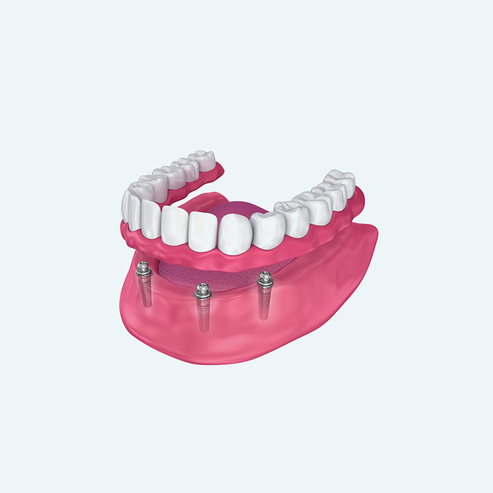 Upper and lower dentures attached to dental implants, pink gums, white teeth.