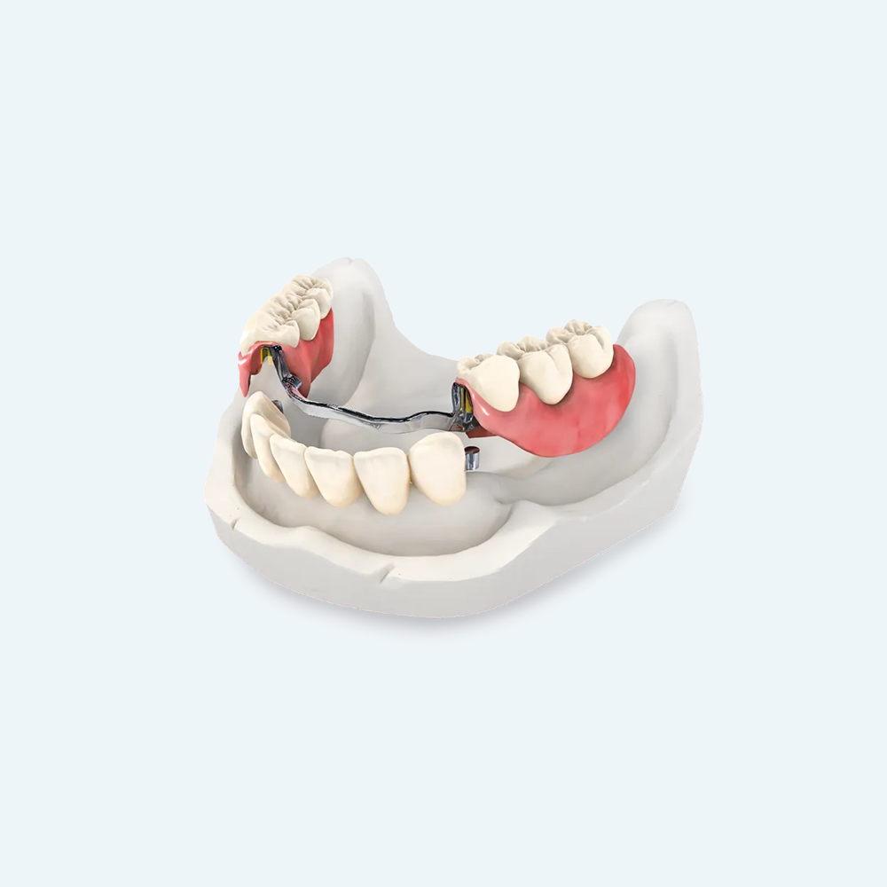 Partial denture model showing replacement teeth on a pink base, attached with metal framework.