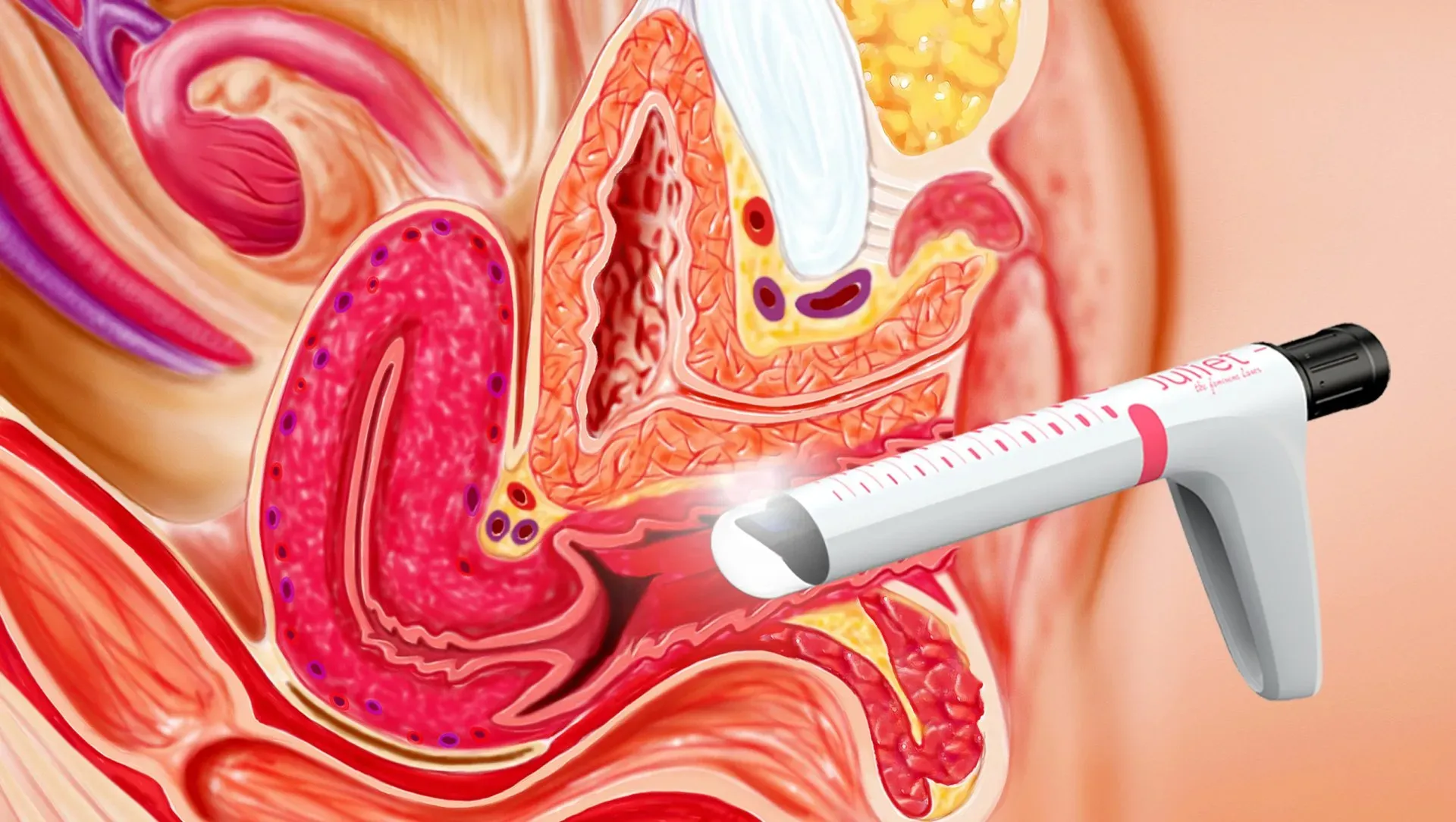 Trans Vaginal Ultra Sound | Tucson, AZ | A New Creation Clinic and Medi-Spa