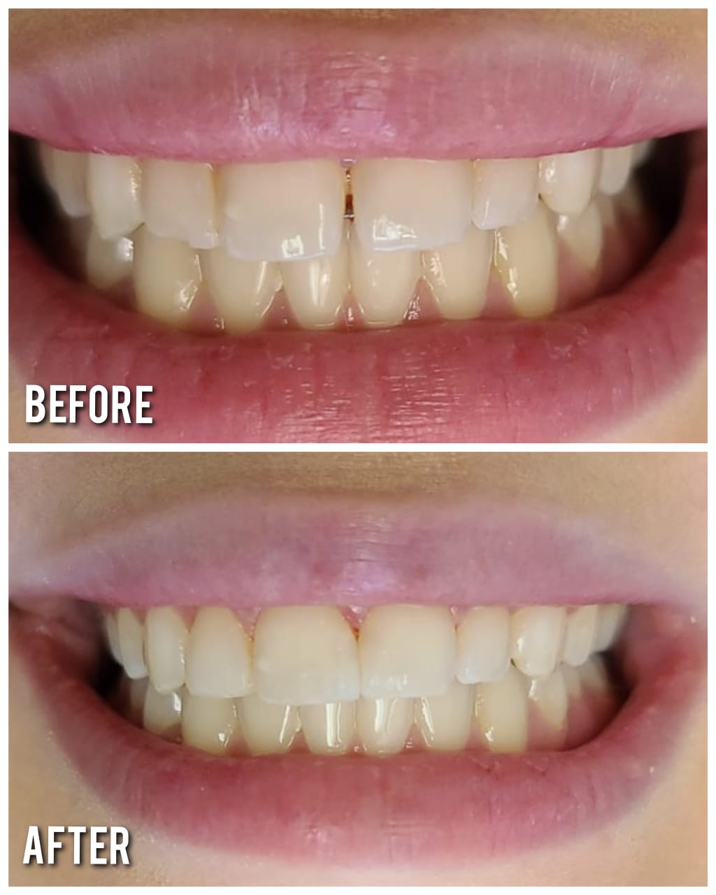 a before and after picture of a person 's teeth