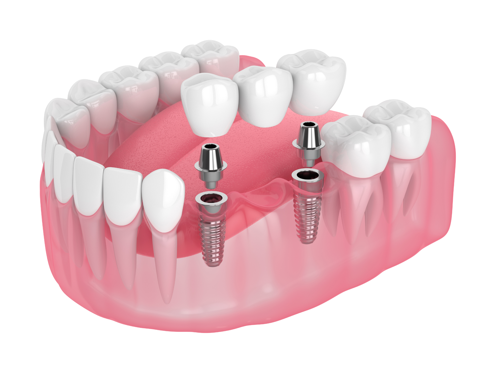 a 3d rendering of a dental bridge with dental implants .
