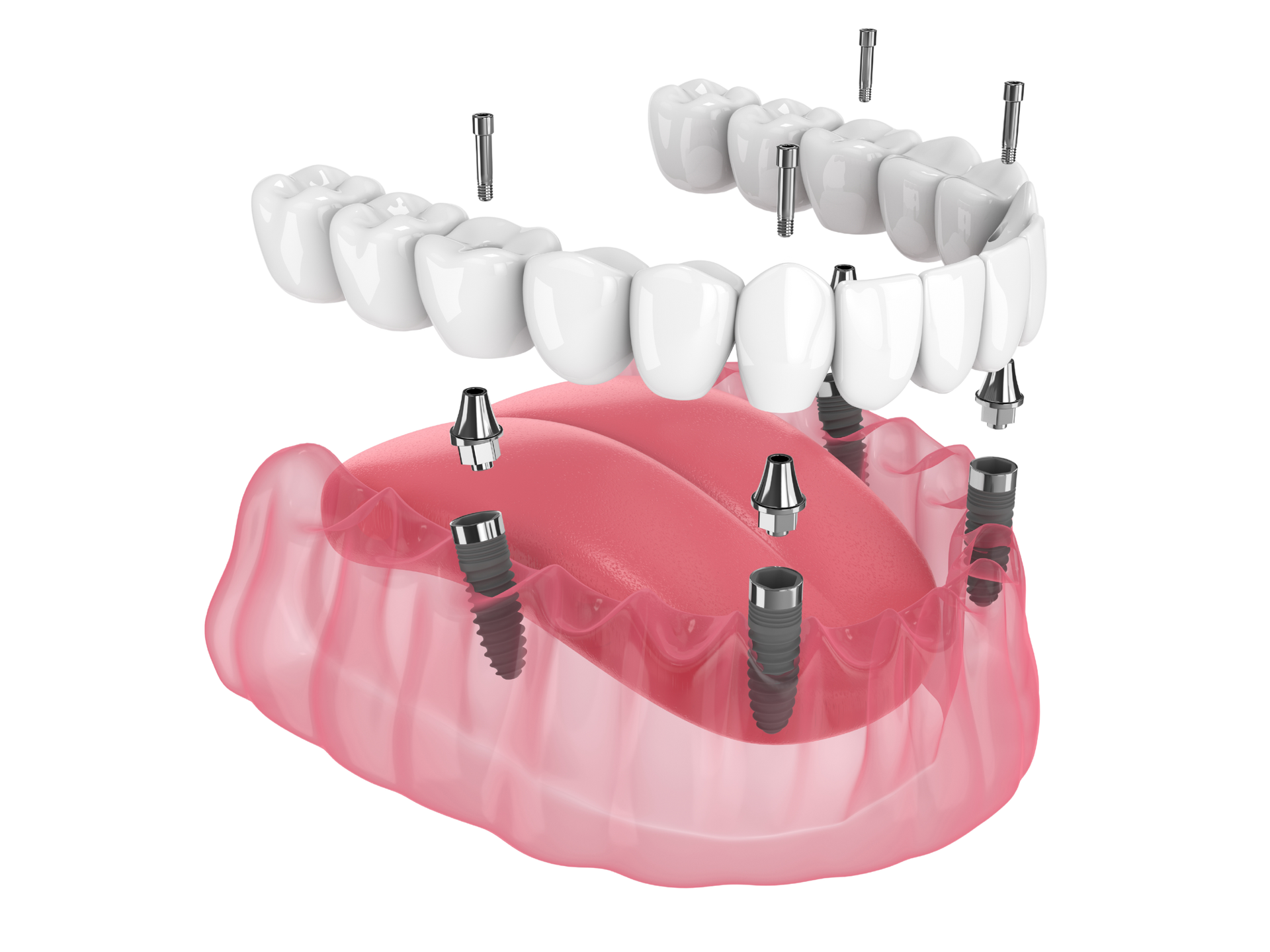 a model of a full denture with dental implants .