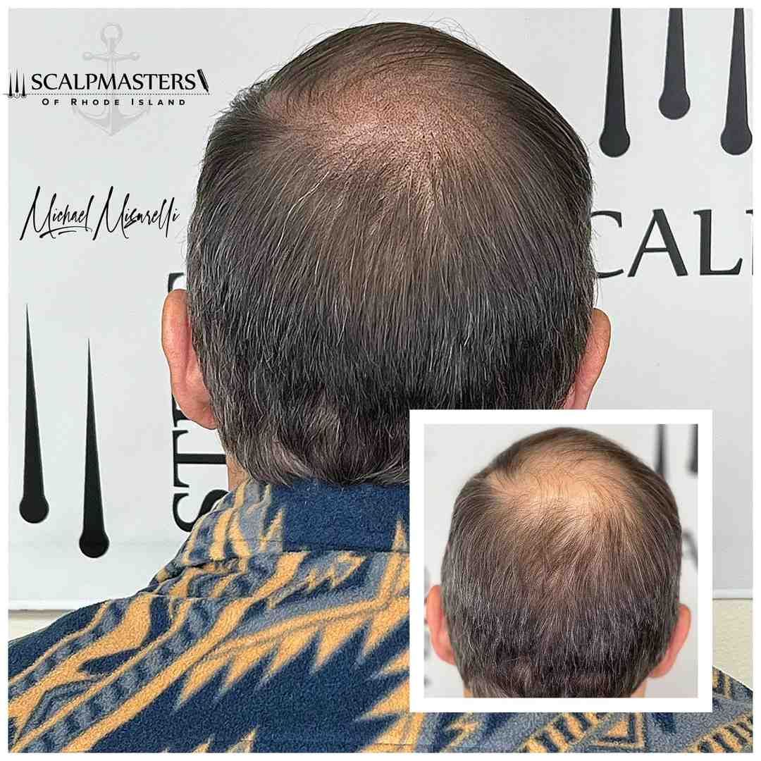 scalp micropigmentation rhode island