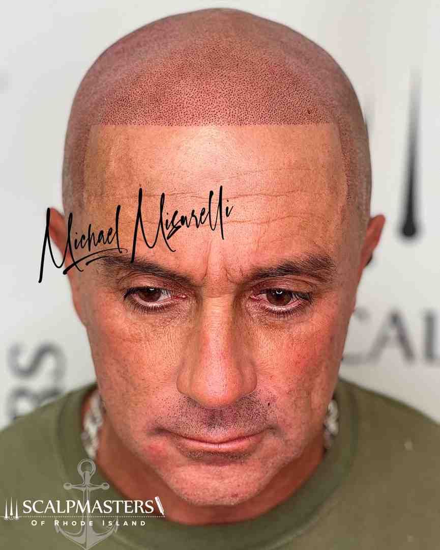 scalp micropigmentation connecticut