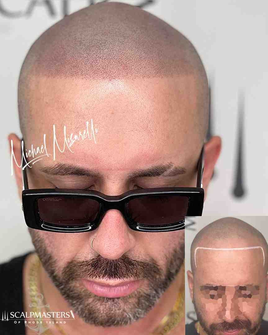 scalp micropigmentation for men - smp for men