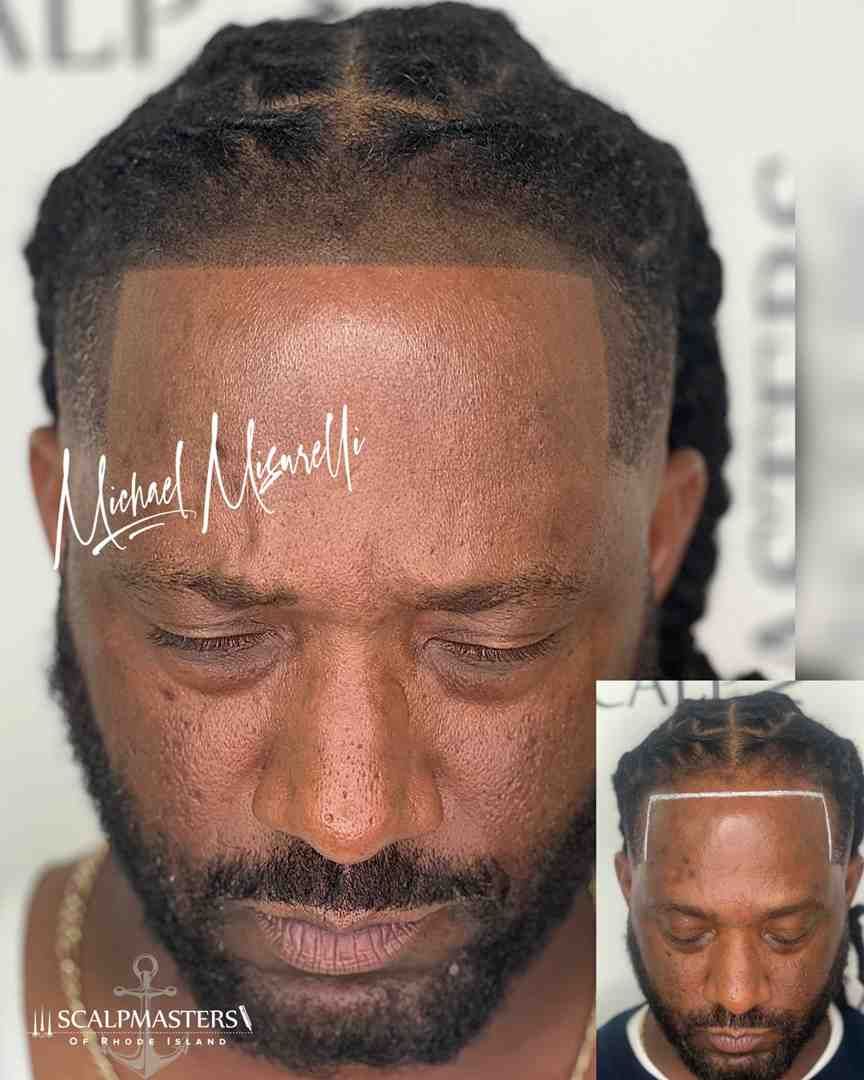 treatments for receding hairline