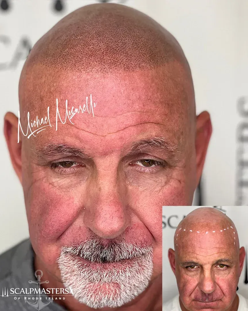 Rhode Island hair tattoo scalp micropigmentation results confident man - rhode island hair tattoo