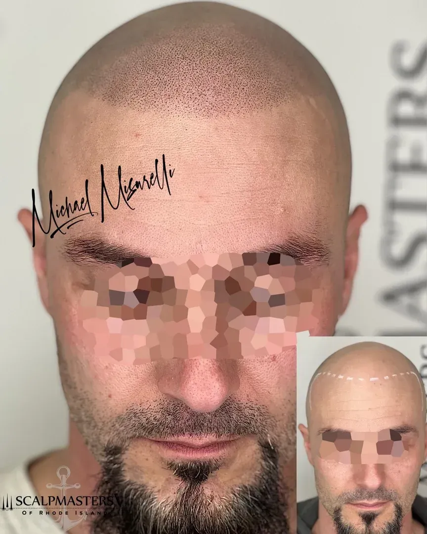 scalp micropigmentation near me transformation - smp scalp micropigmentation near me
