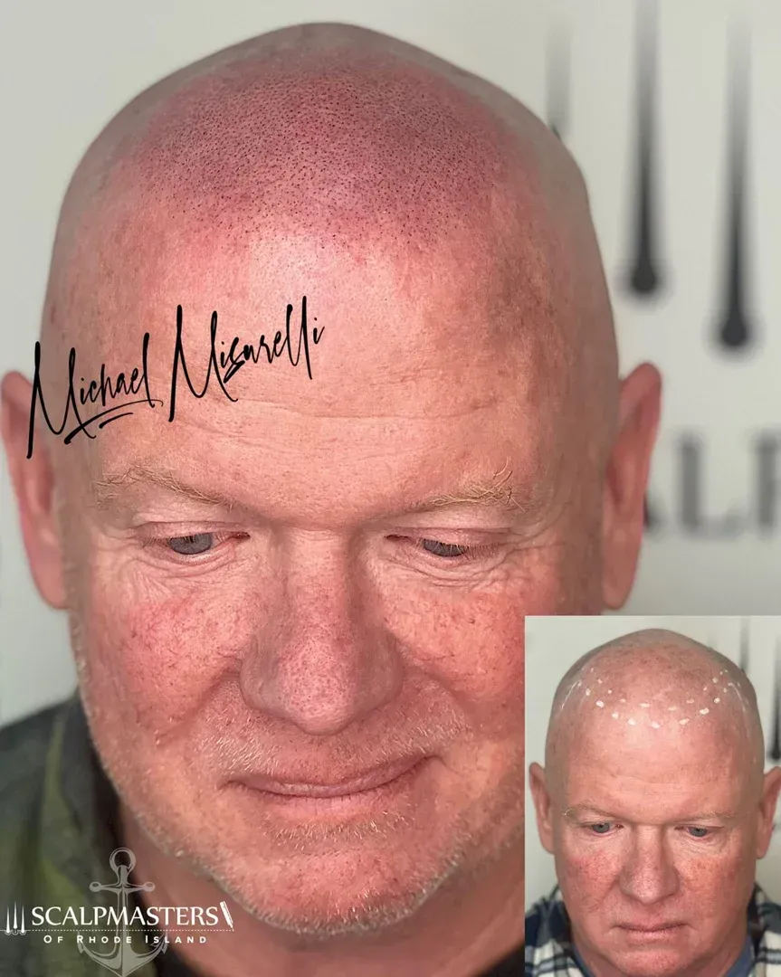 rhode island scalp tattoo results hair restoration confidence
