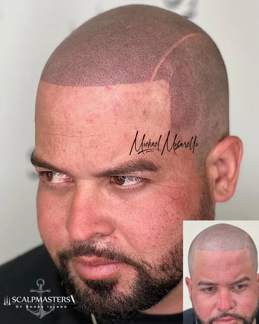 scalp micropigmentation hartford ct