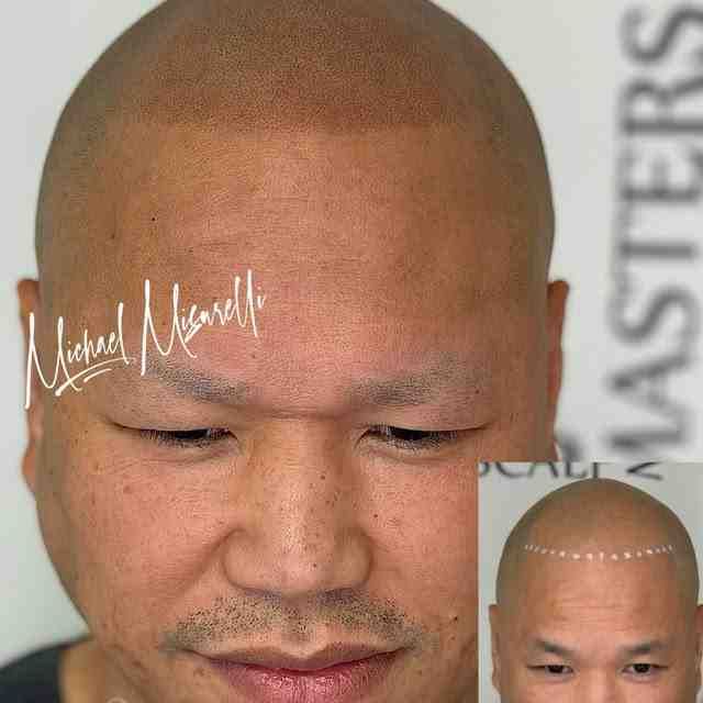 micropigmentation hair loss