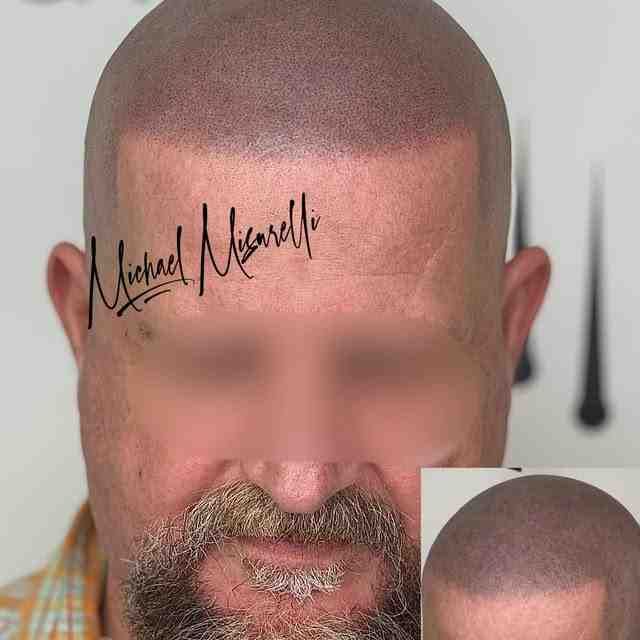 Hair restoration tattoo