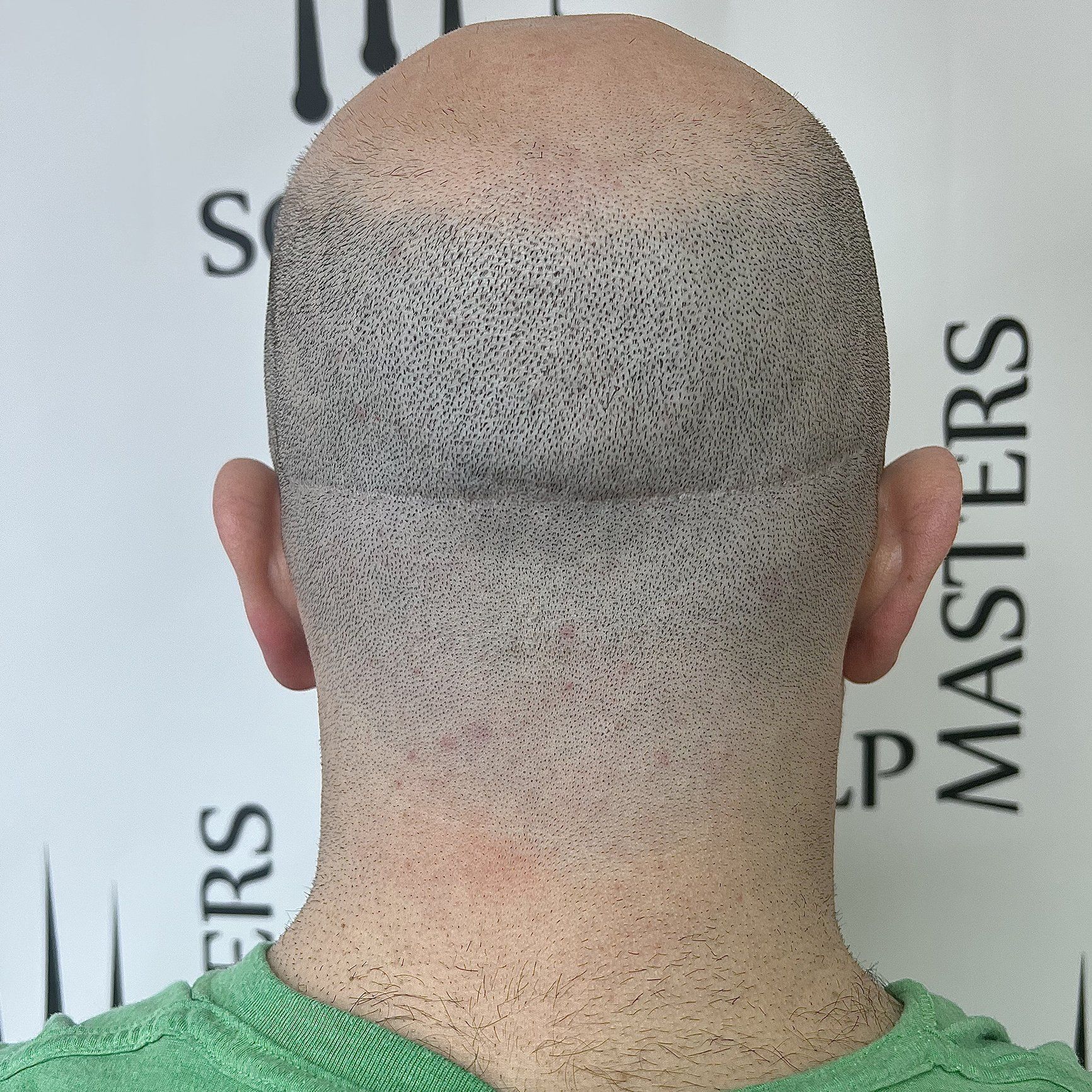 scalp micropigmentation treatment