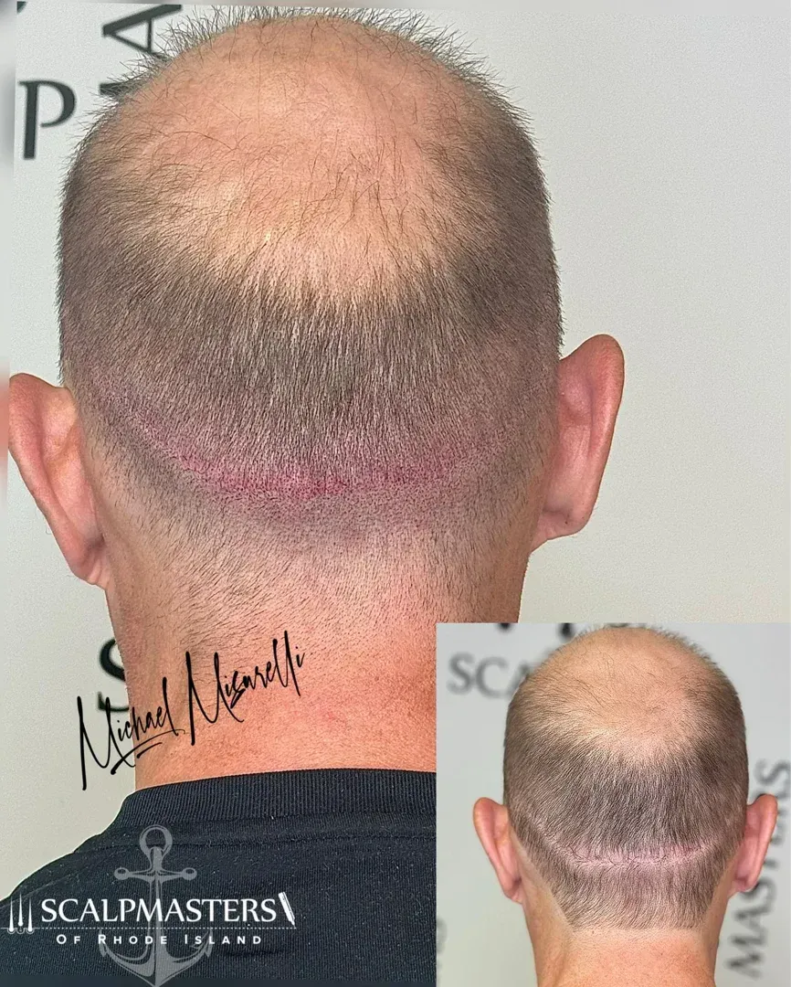 scalp scar cover up before and after - scalp scar cover up