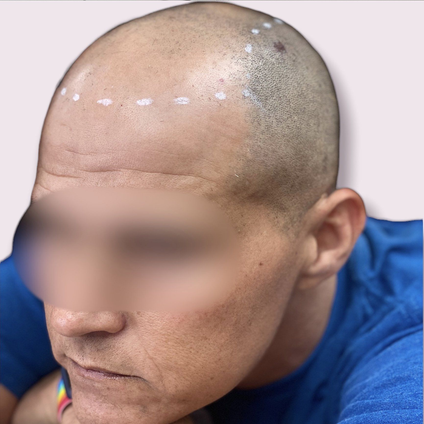 Scalp Micropigmentation Before & After Photos