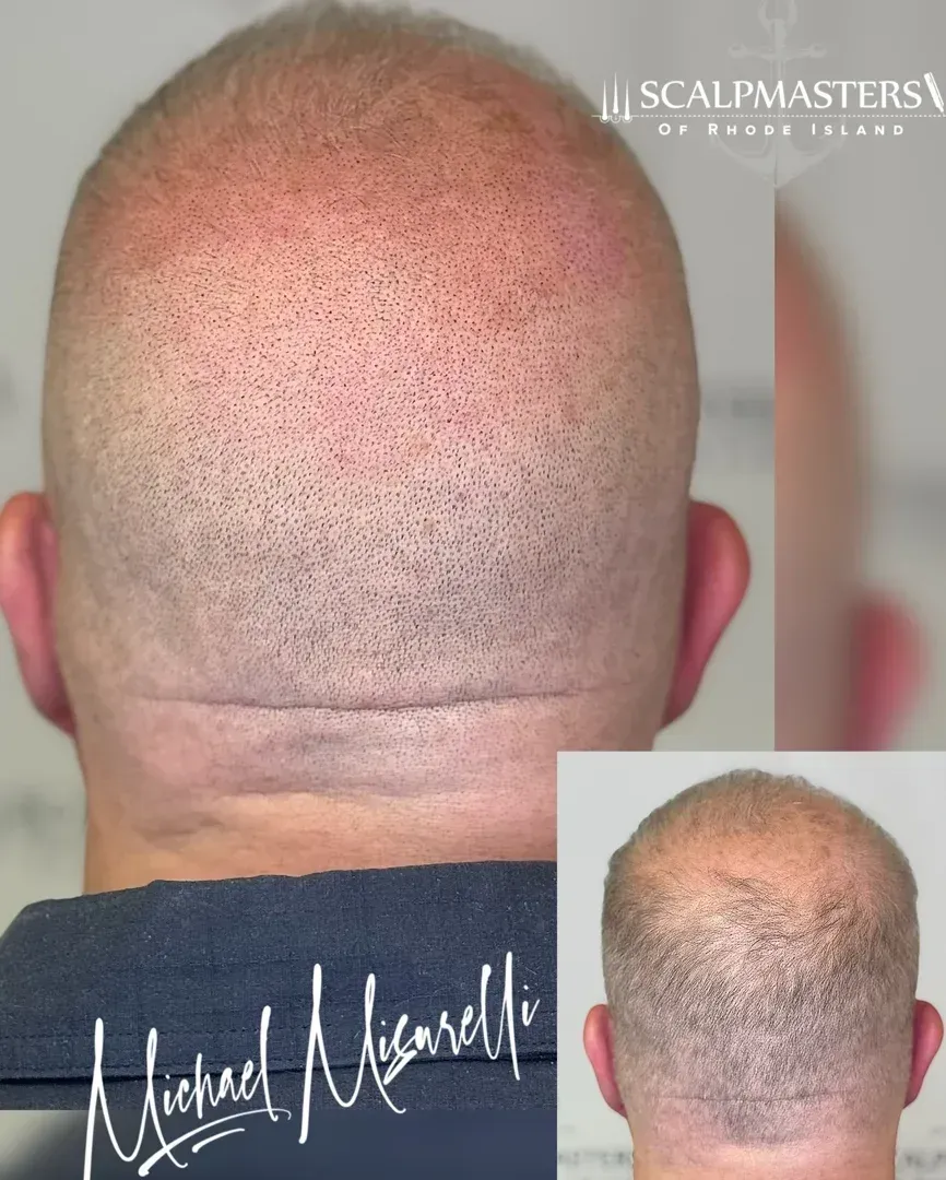 Natural hairline restoration before and after scalp micropigmentation