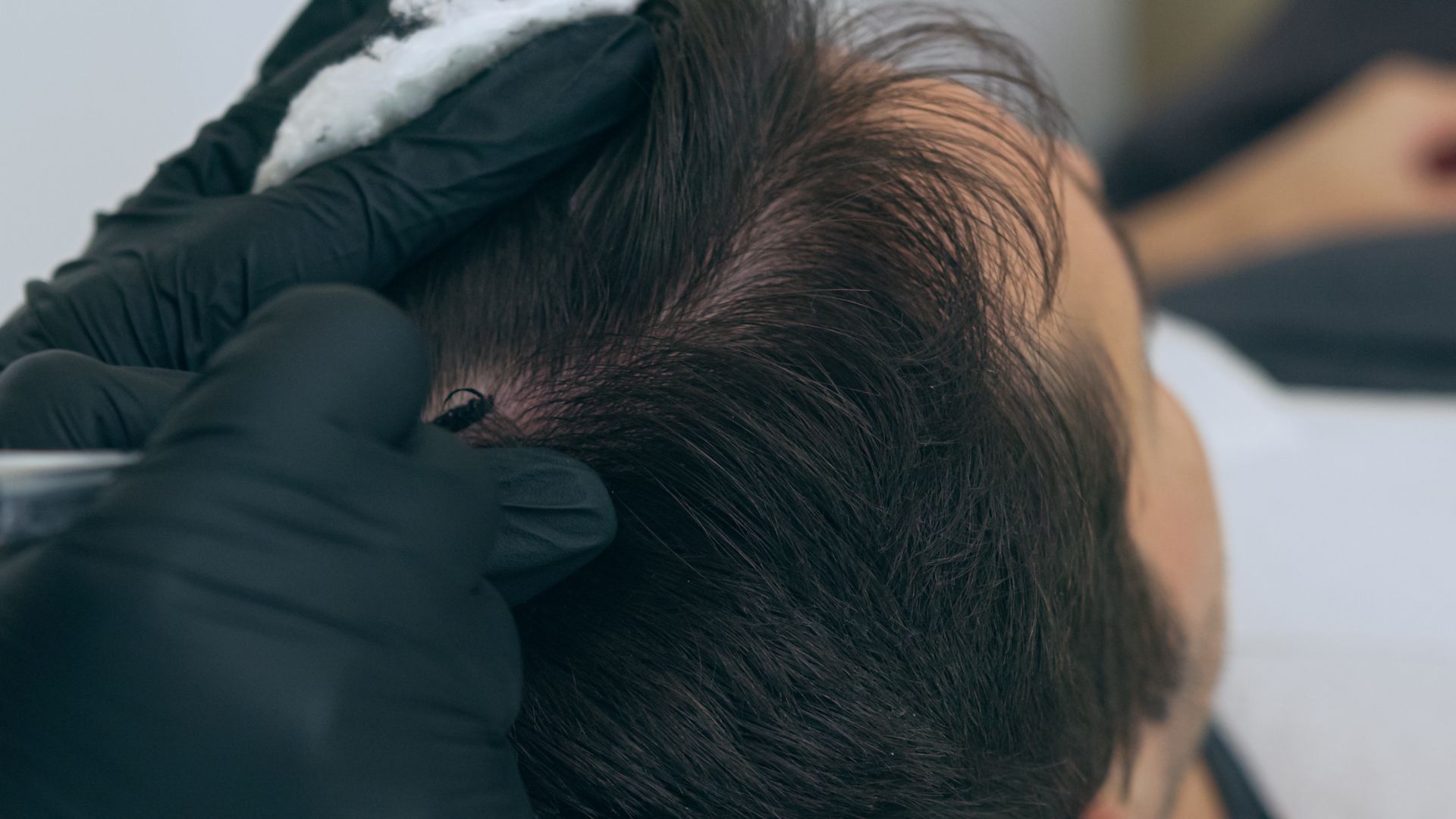 The Scalp Micropigmentation Procedure