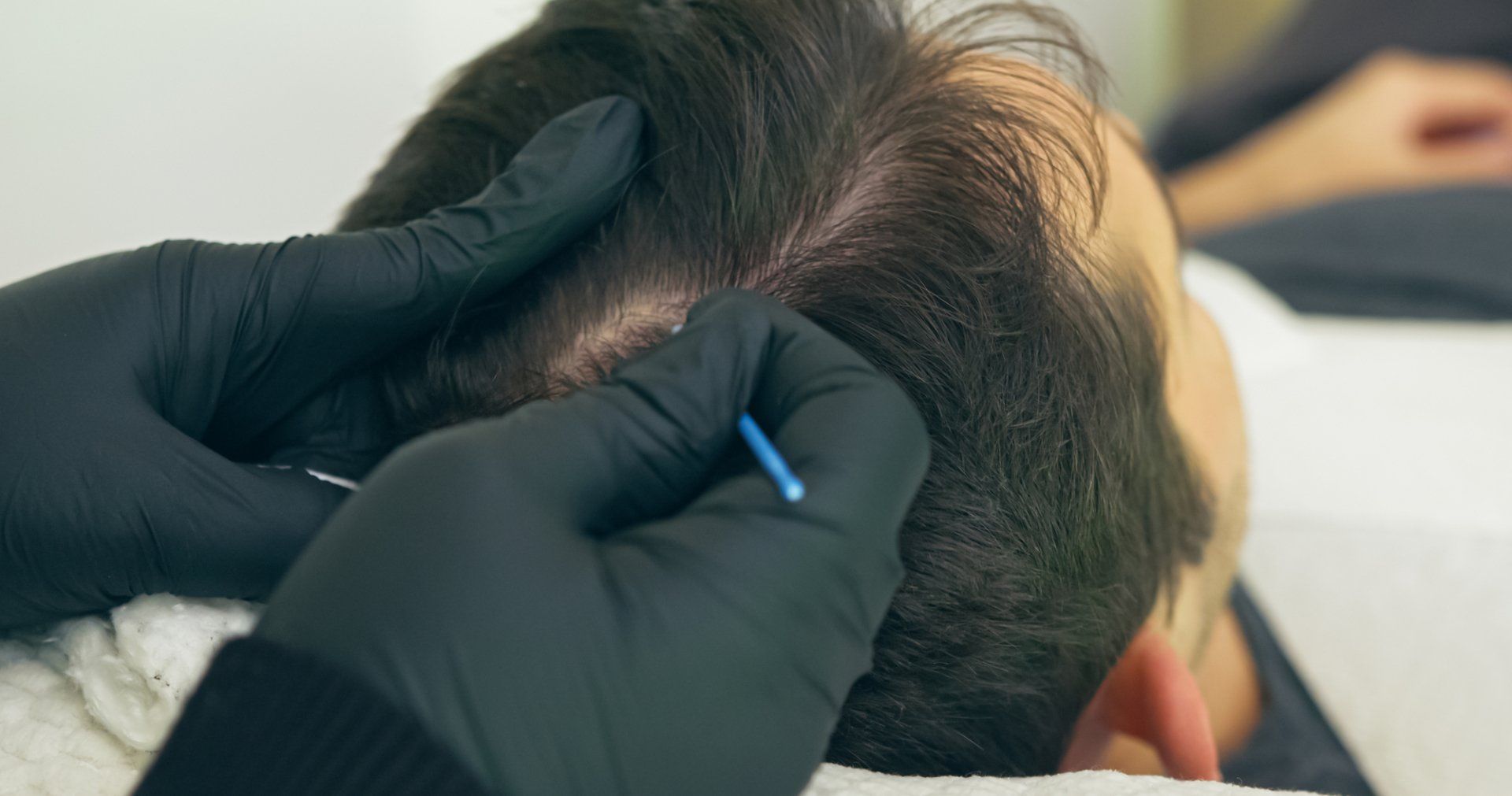 How to Resolve a Botched Scalp Micropigmentation