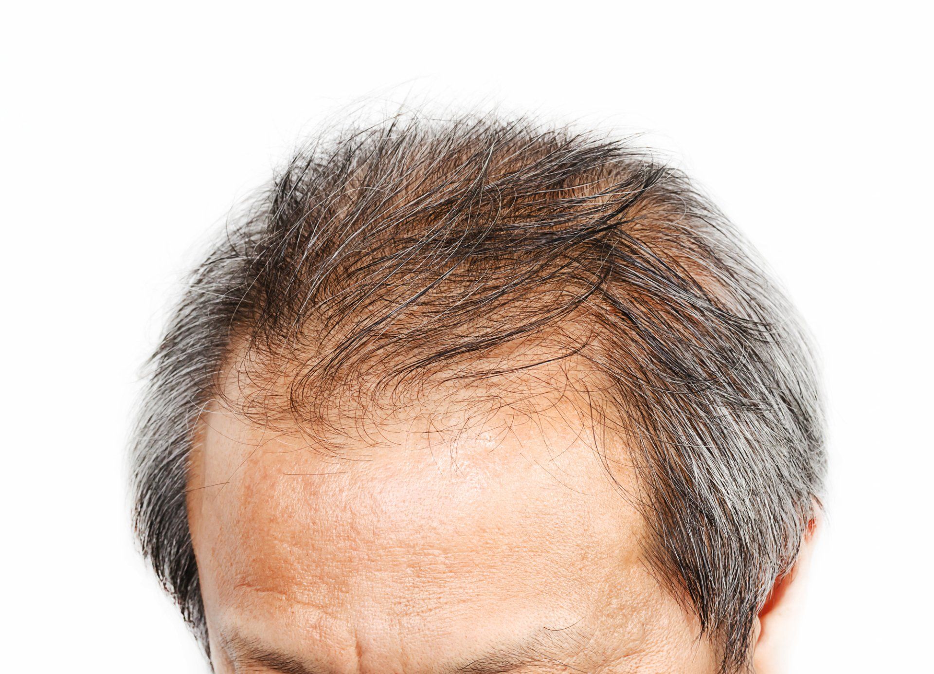 What You Need to Know About Losartan and Hair Loss