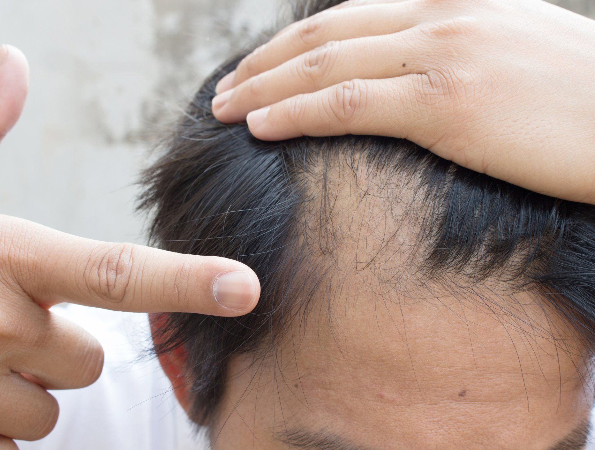 Nexplanon and Hair Loss: What You Need to Know