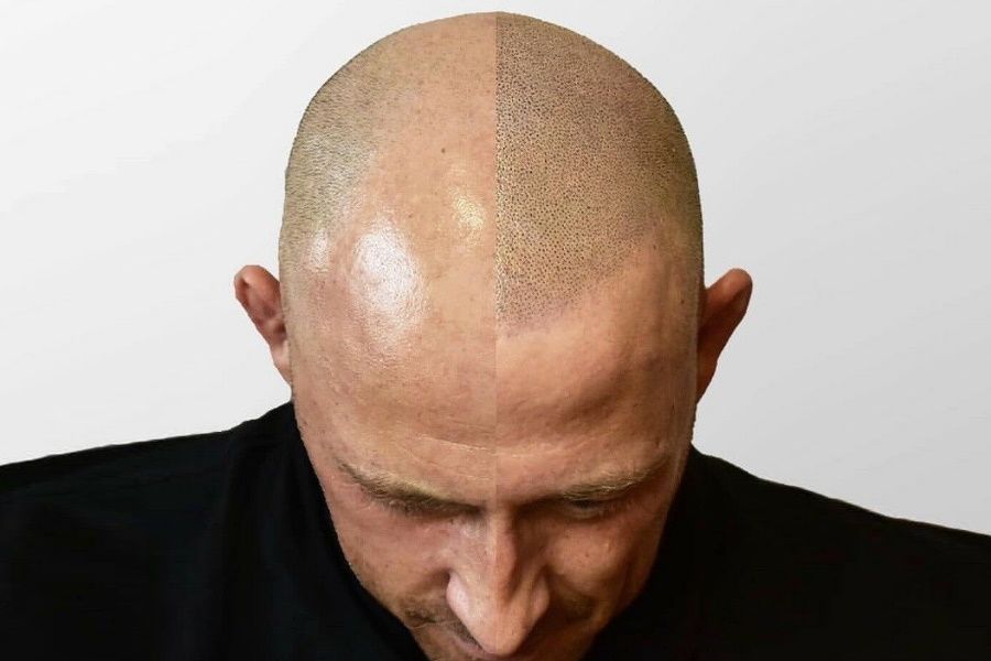 Scalp Micropigmentation Benefits Side Effects Before  After Pics