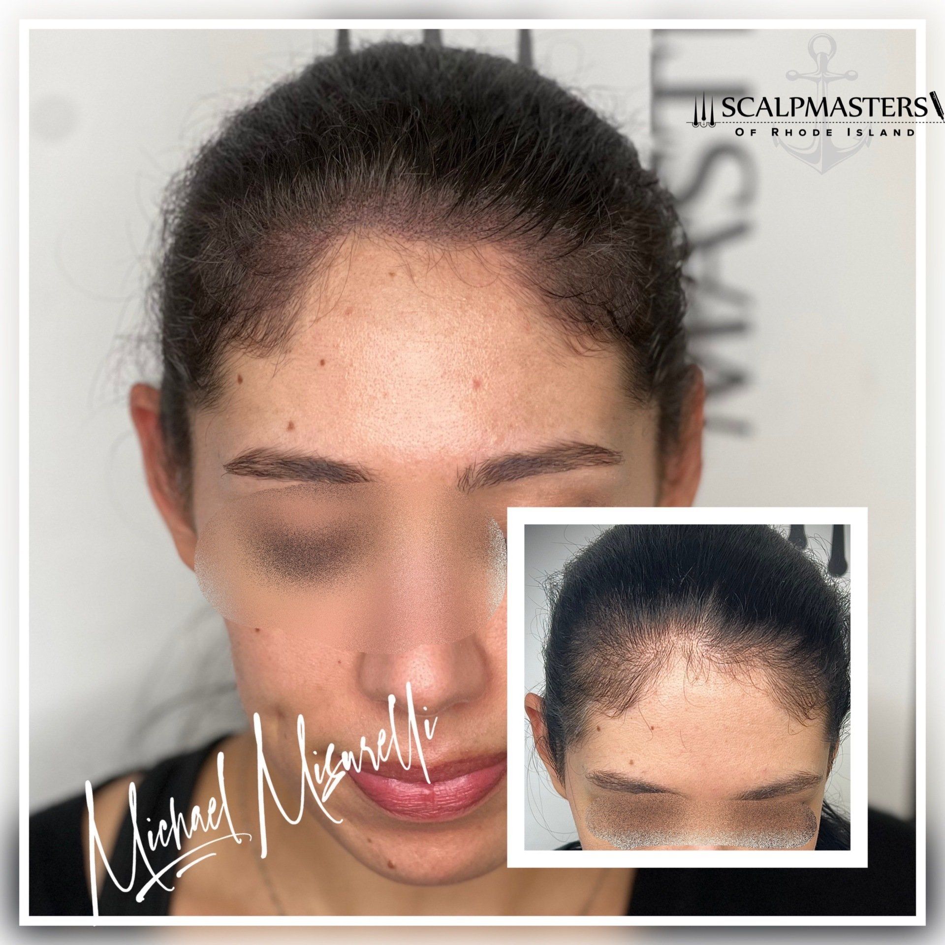 Scalp Micropigmentation for Women