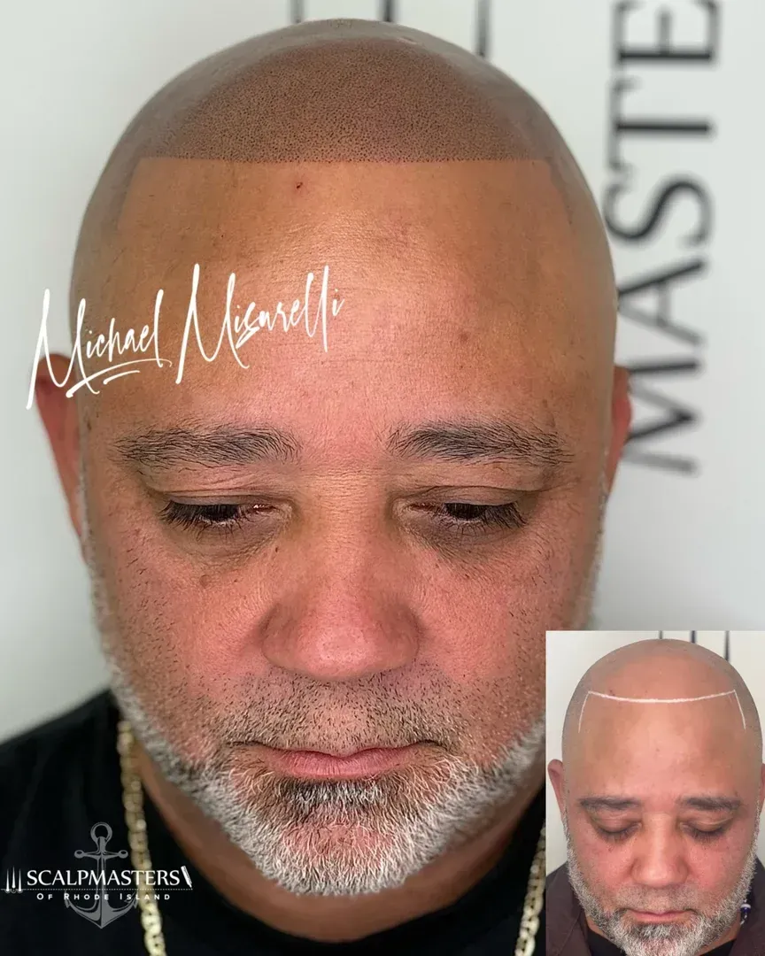 scalp micropigmentation before after
