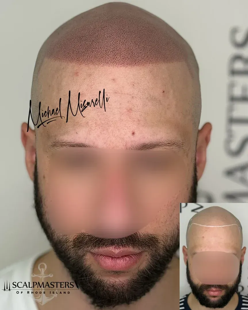 providence micropigmentation clinic scalp treatment Rhode Island - providence micropigmentation clin