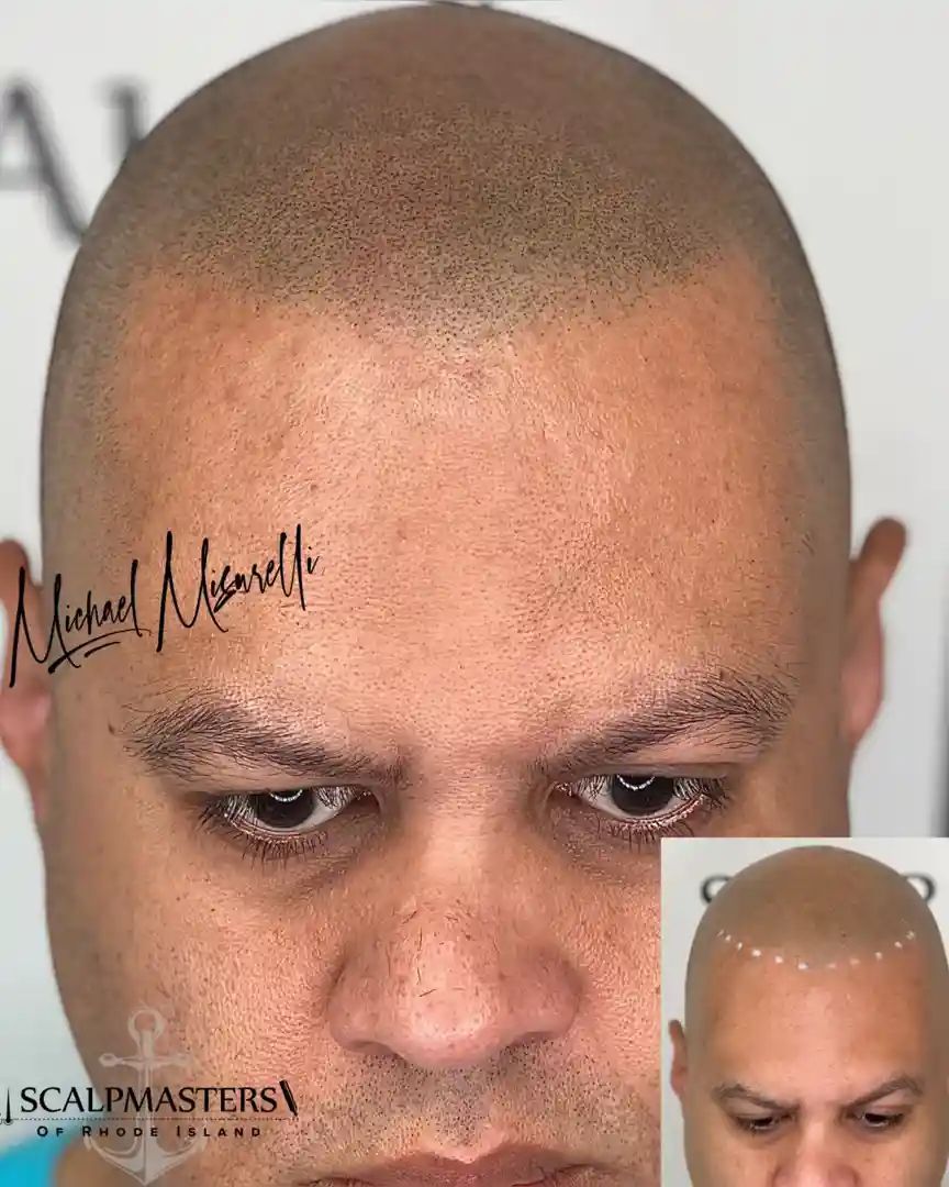 head tattoo for baldness