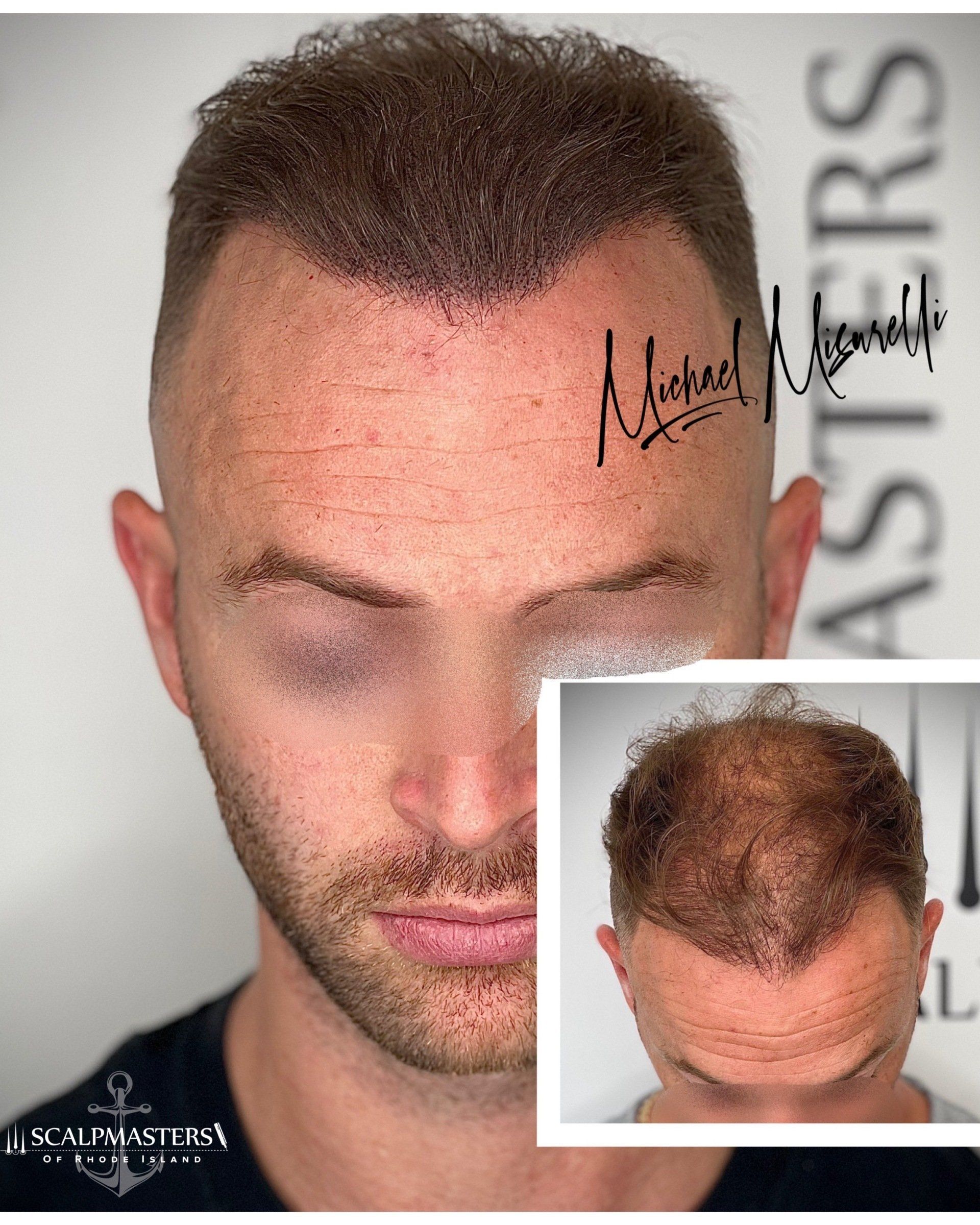 Scalp Micropigmentation for Women