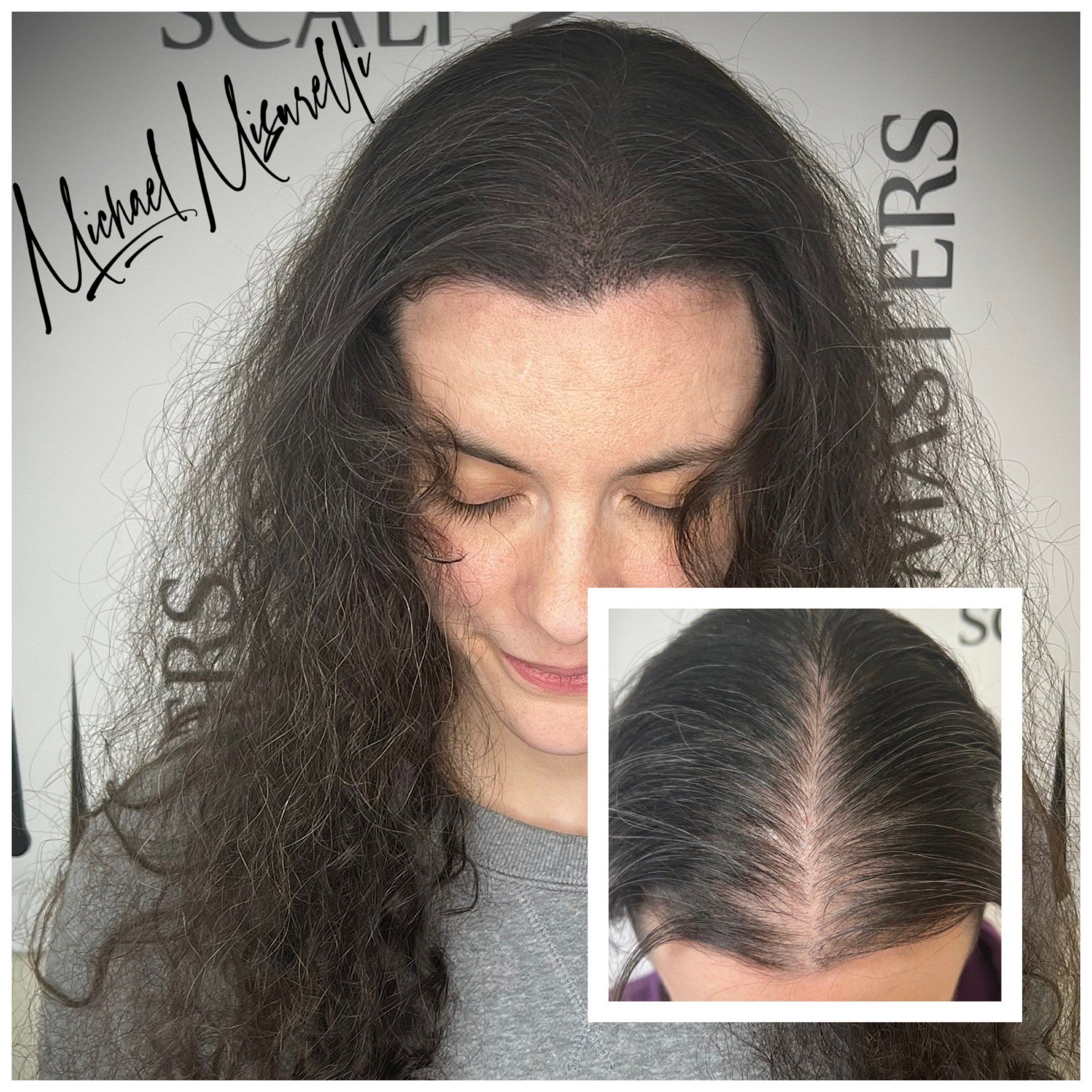 Scalp Micropigmentation for Women