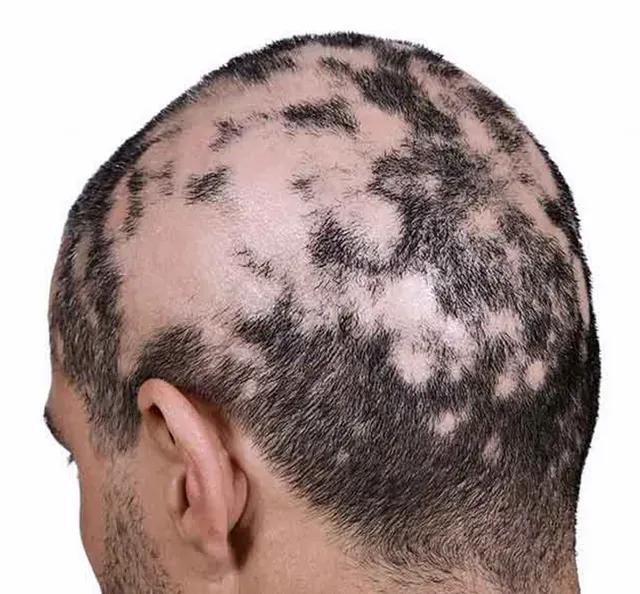 back of scalp with alopecia