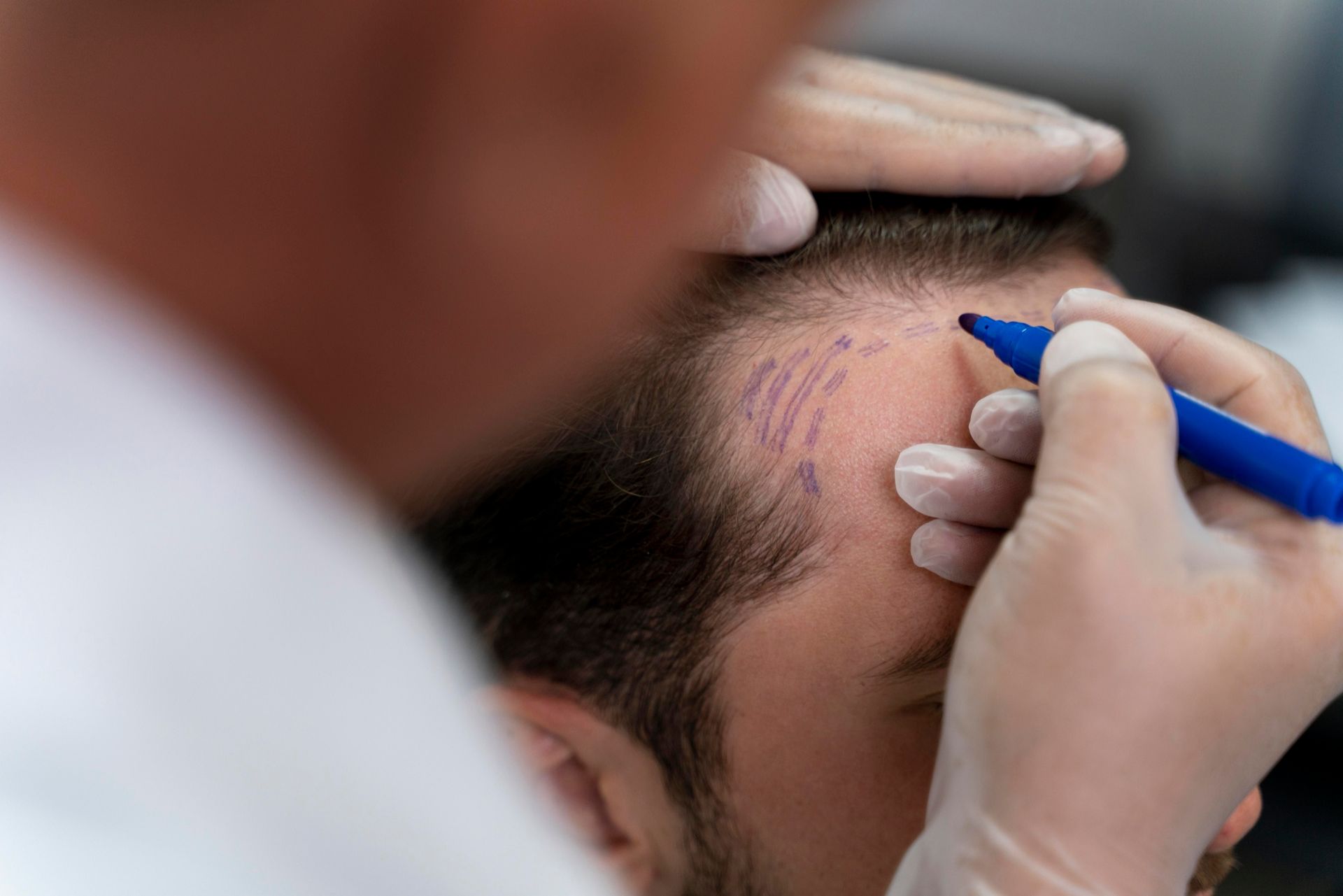 what is scalp micropigmentation for men