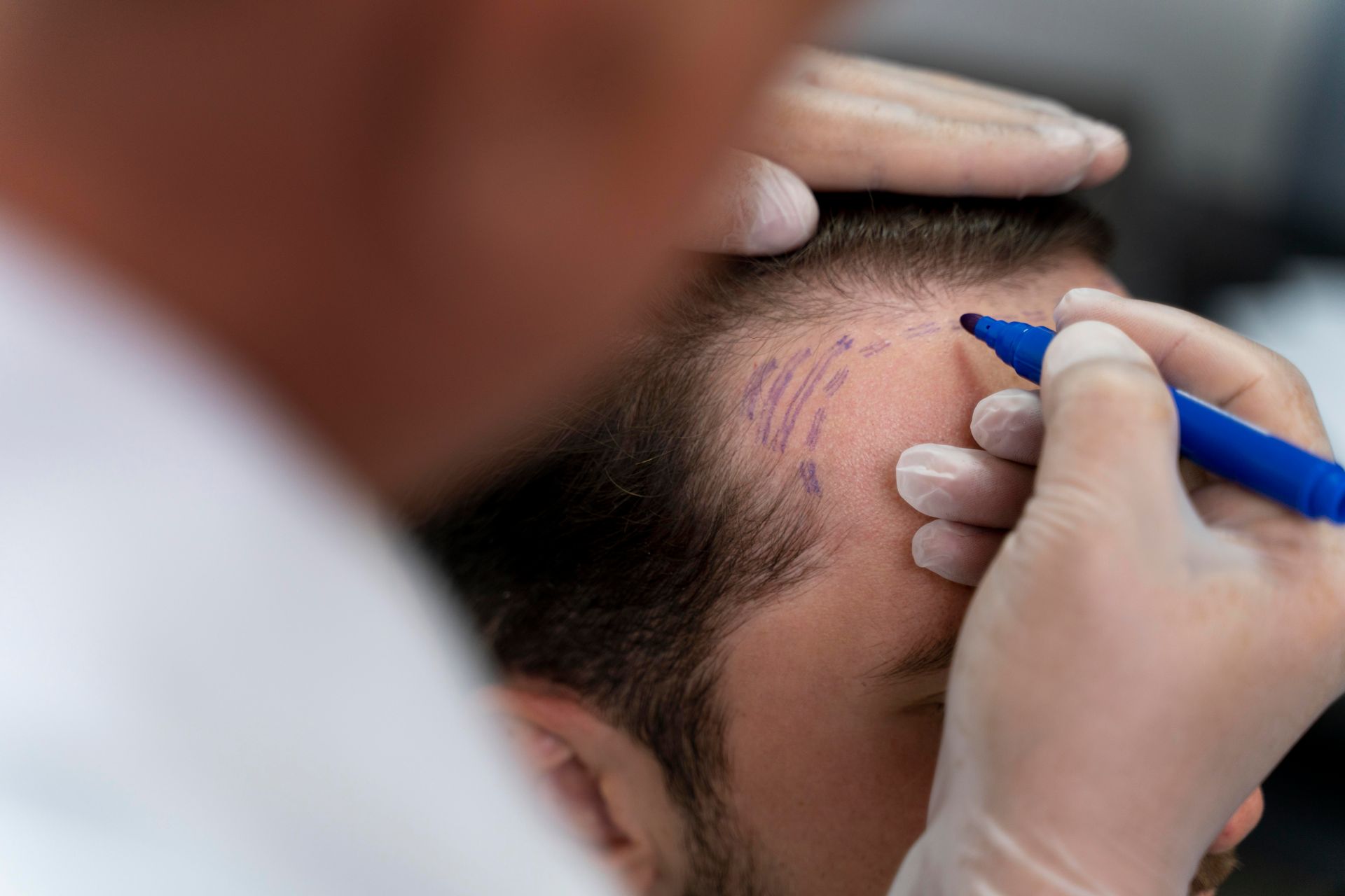 Scalp Micropigmentation in Warwick, RI