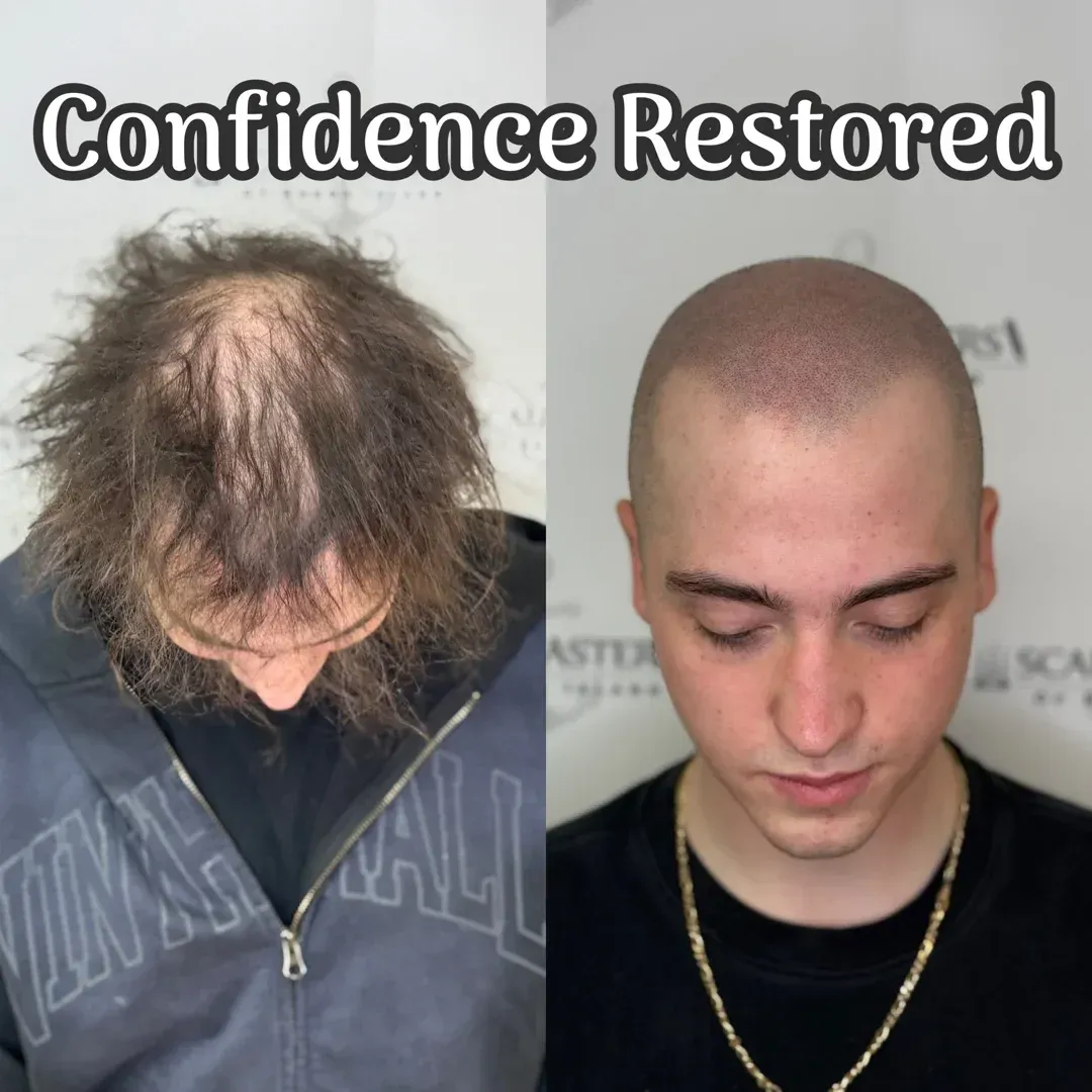 scalp micropigmentation alopecia
