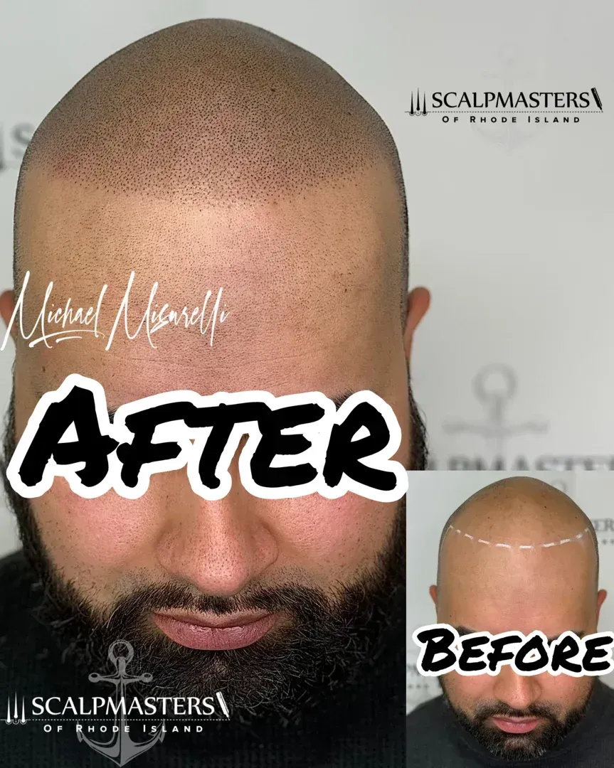 scalp micropigmentation results - cost of scalp micropigmentation near me