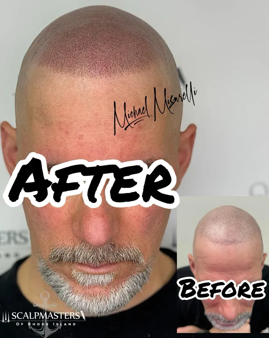 scalp micropigmentation for men