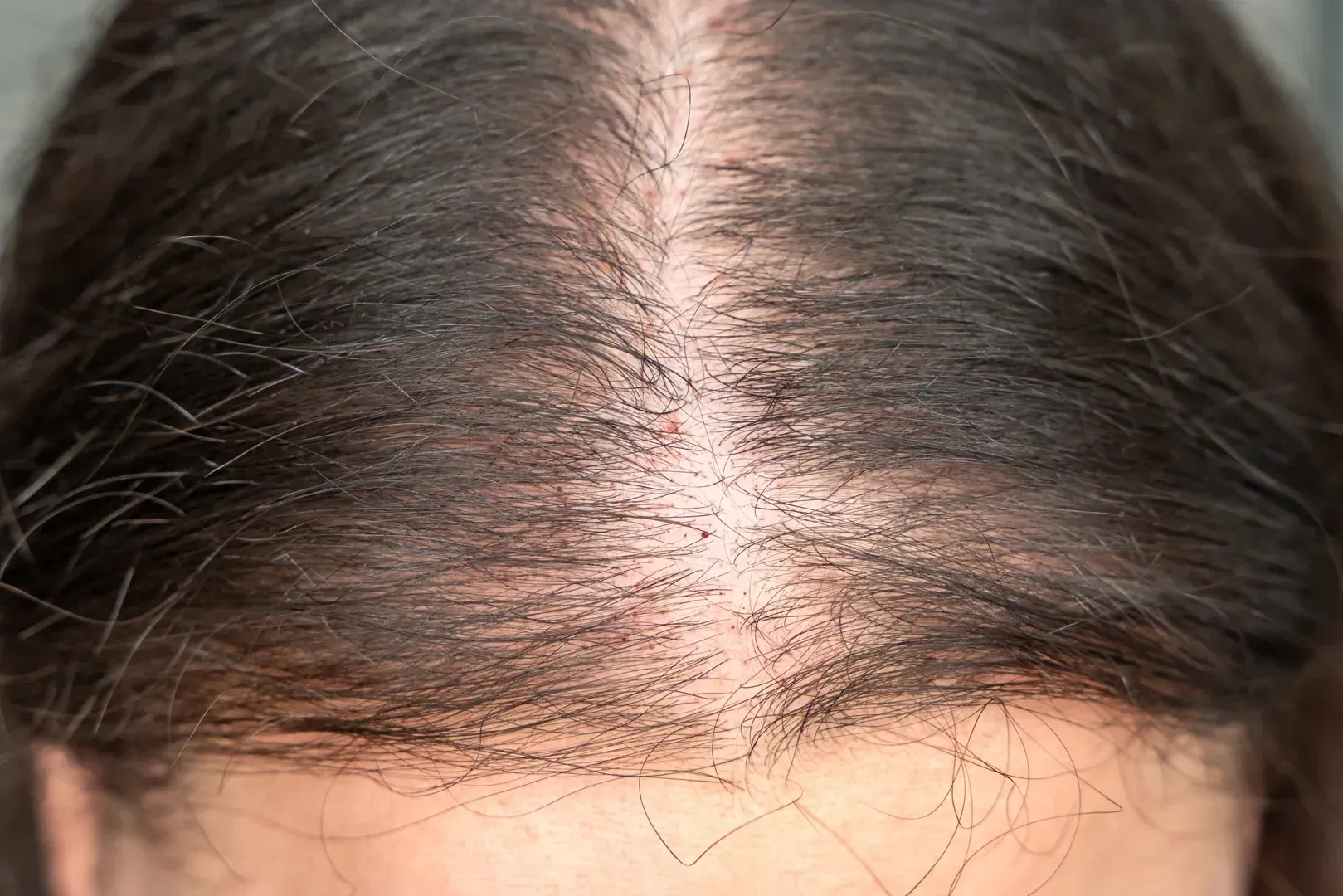 providence scalp tattoo natural hairline results