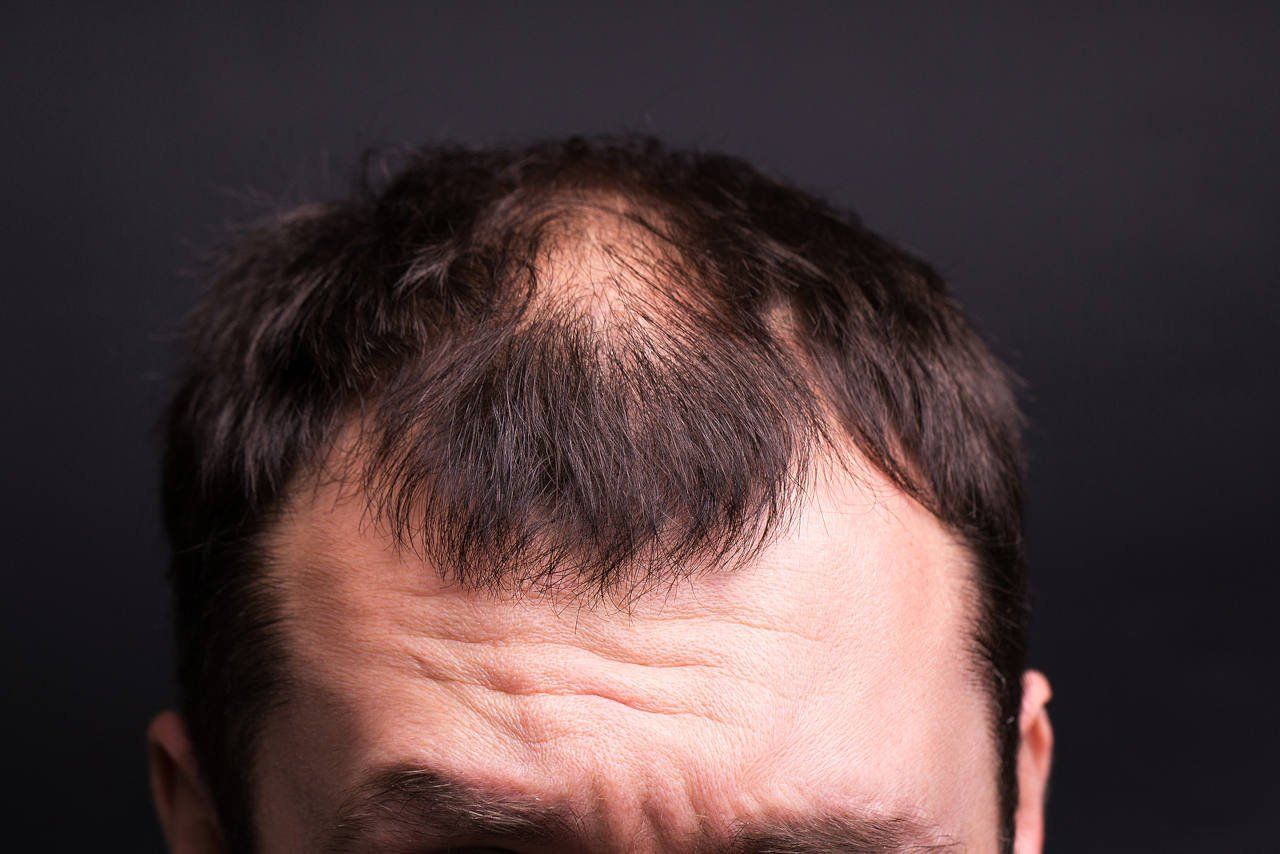 man with SMP work done on head