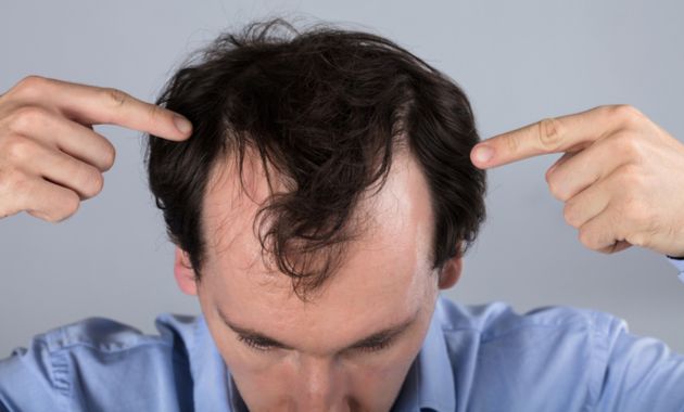 What Is DHT Hair Loss And How Is It Treated In Ayurveda  Vedix