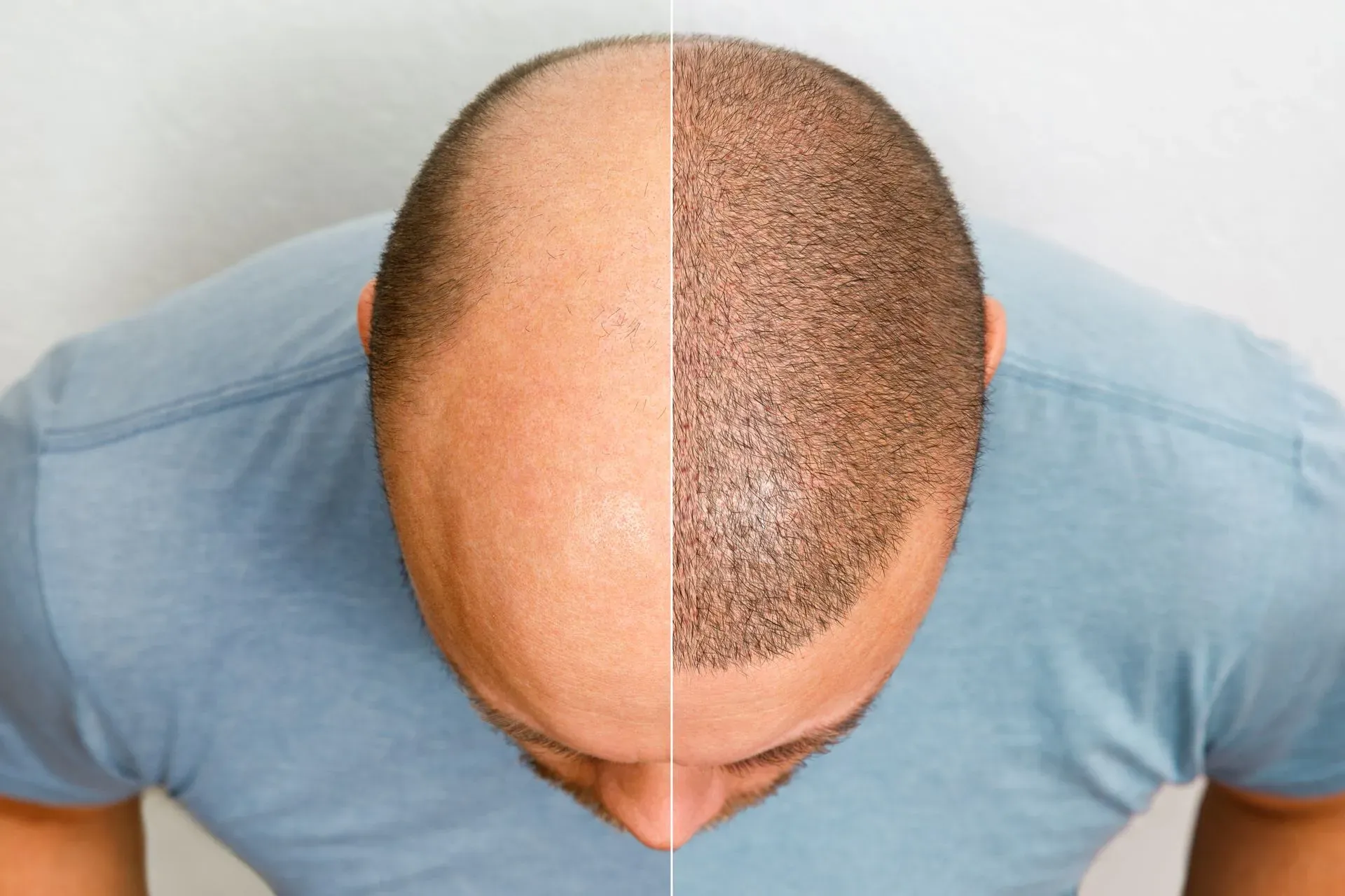 Scalp Micropigmentation