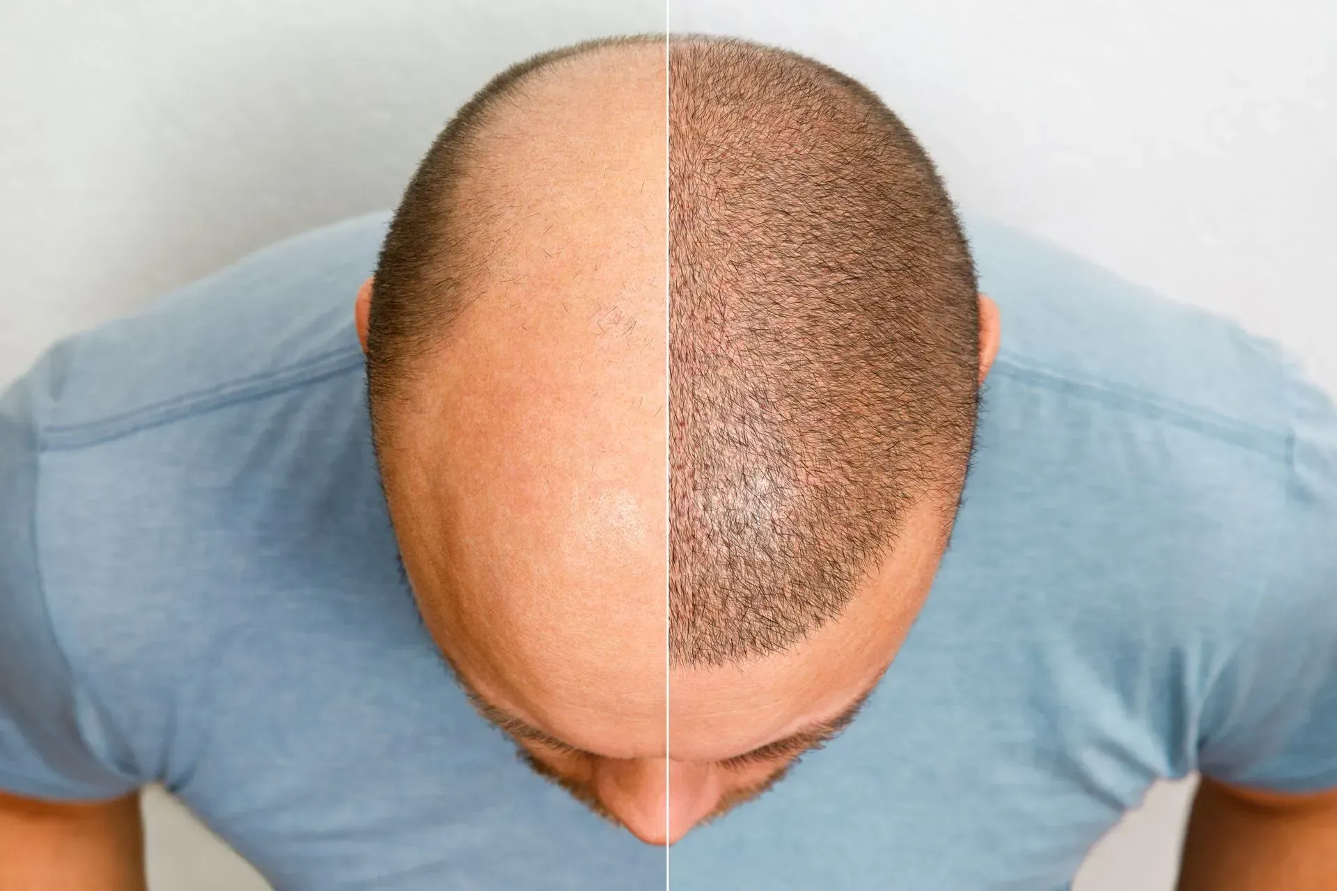 A man 's head is shown before and after a hair transplant.