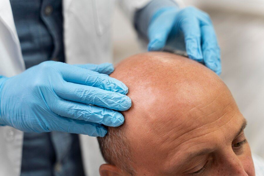 Benefits of scalp micropigmentation