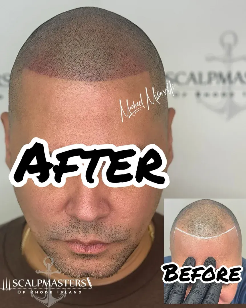 pawtucket hairline tattoo natural results scalp micropigmentation