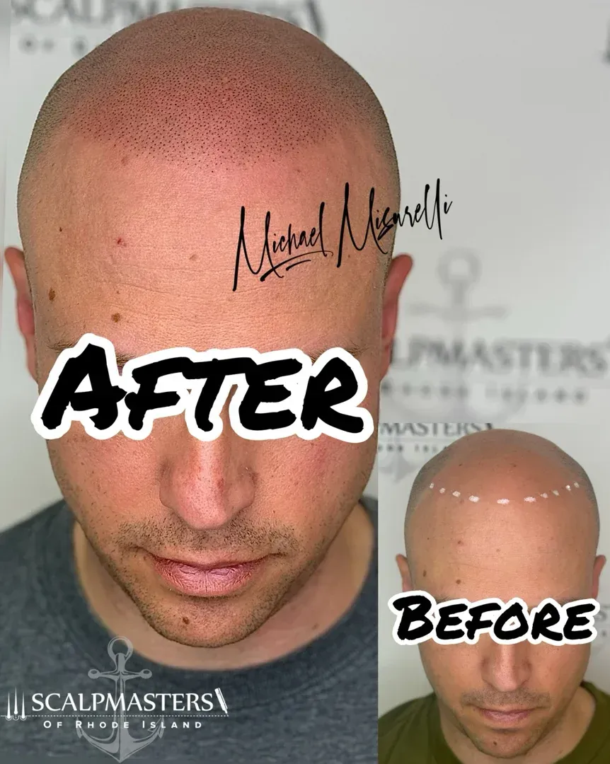 scalp micropigmentation hair tattoo transformation - hair tattoo reddit